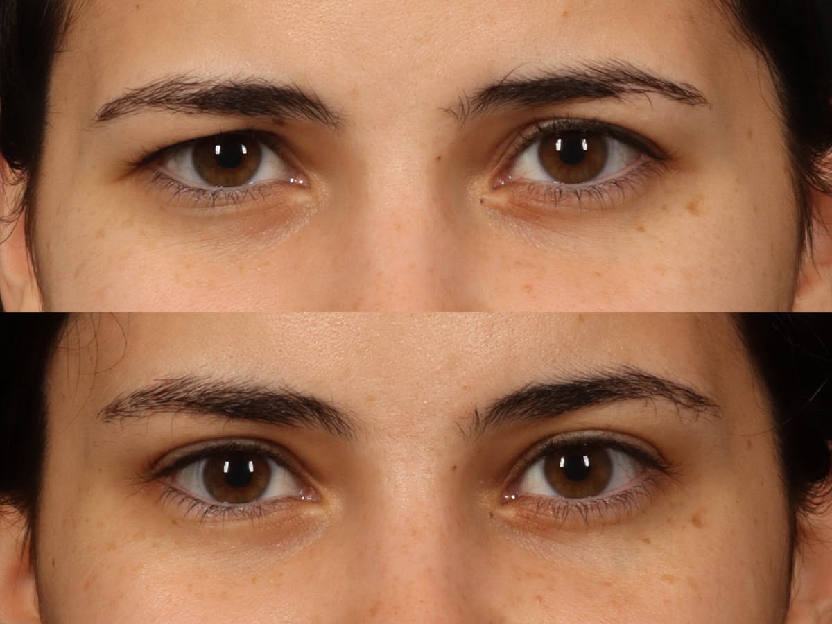 Blepharoplasty Before & After Gallery - Patient 535690 - Image 4