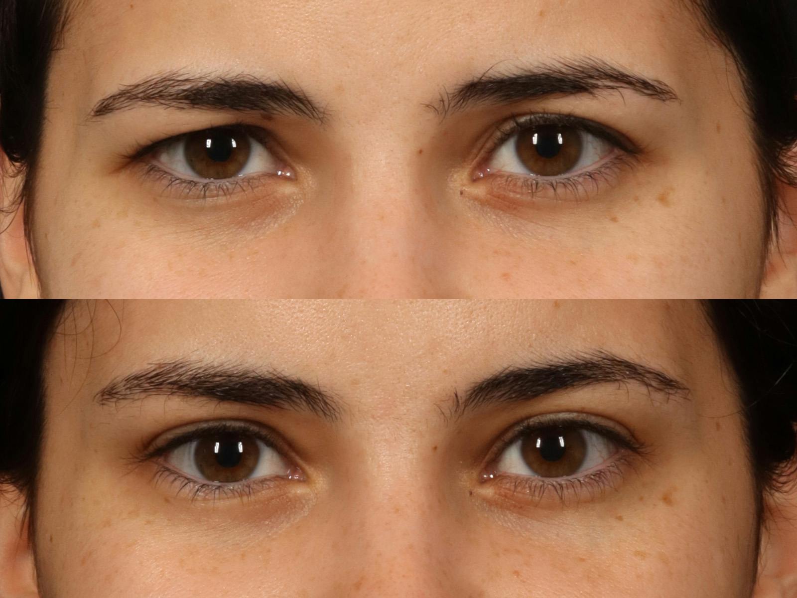 Blepharoplasty Before & After Gallery - Patient 535690 - Image 4