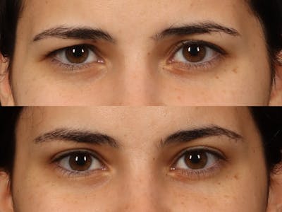 Brow Lift Before & After Gallery - Patient 373182 - Image 2