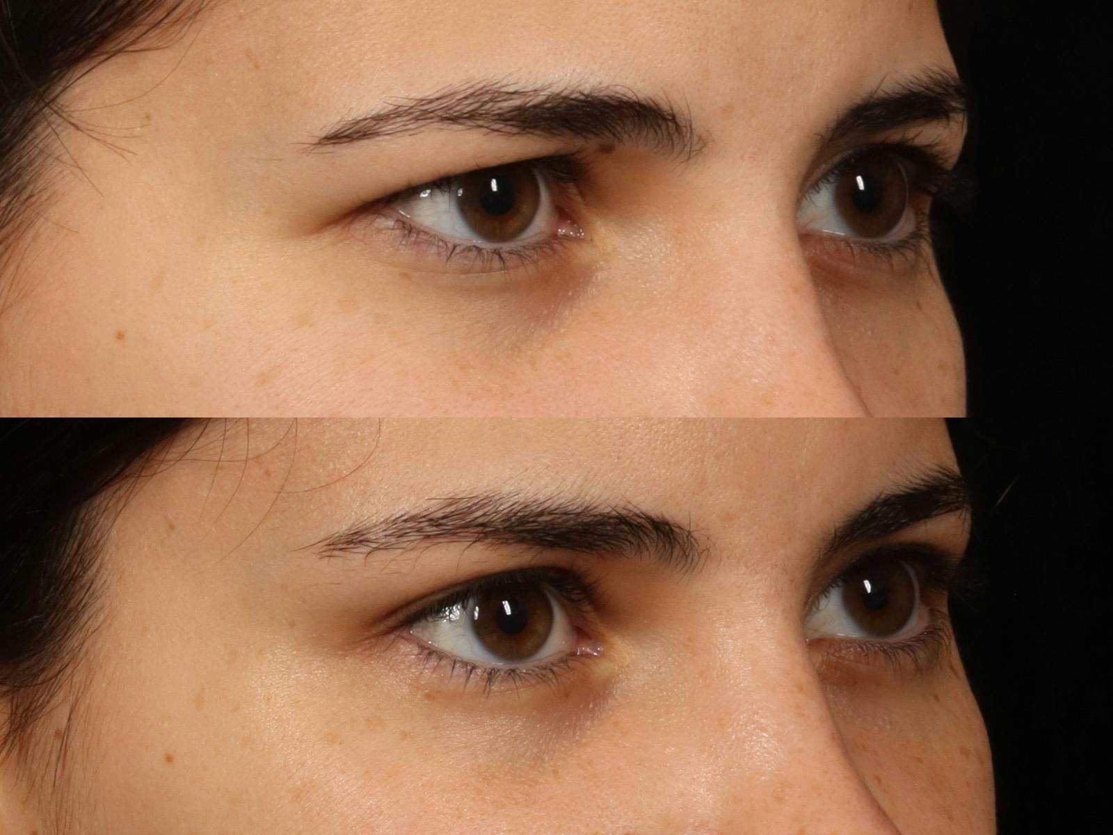 Blepharoplasty Before & After Gallery - Patient 535690 - Image 6