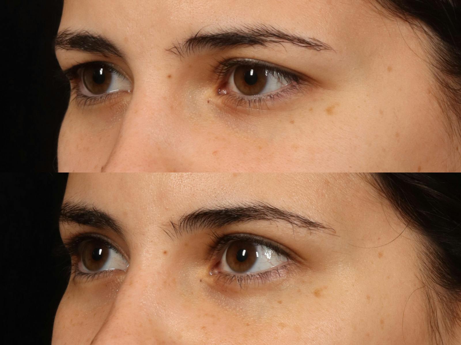 Blepharoplasty Before & After Gallery - Patient 535690 - Image 8