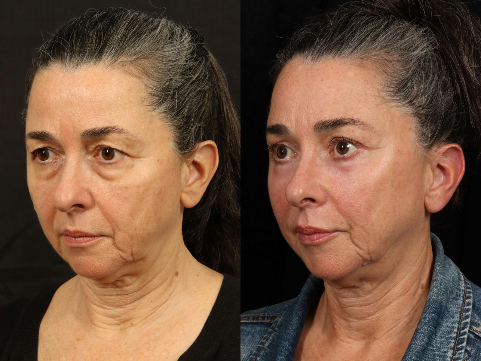 Mid Facelift Before & After Gallery - Patient 156242 - Image 2
