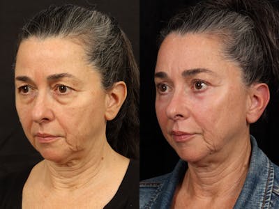 Mid Facelift Before & After Gallery - Patient 156242 - Image 2