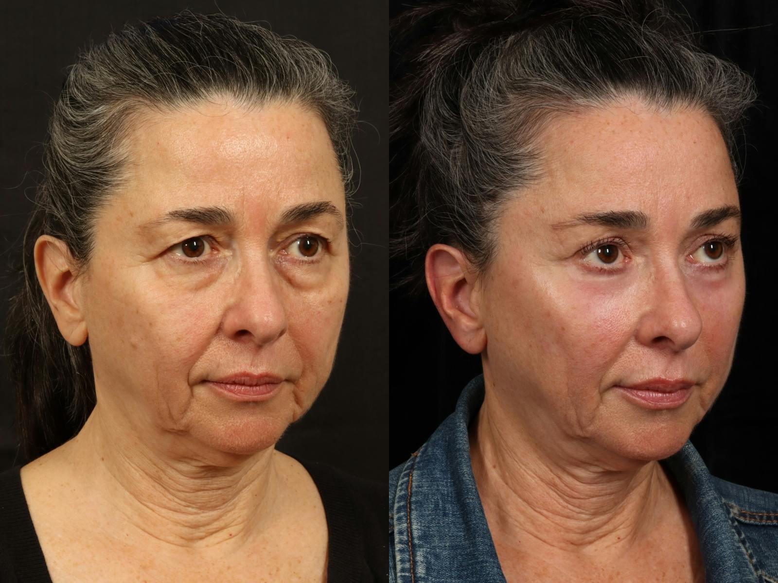 Mid Facelift Before & After Gallery - Patient 156242 - Image 3