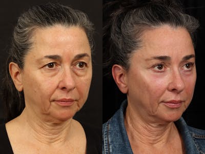 Mid Facelift Before & After Gallery - Patient 156242 - Image 3