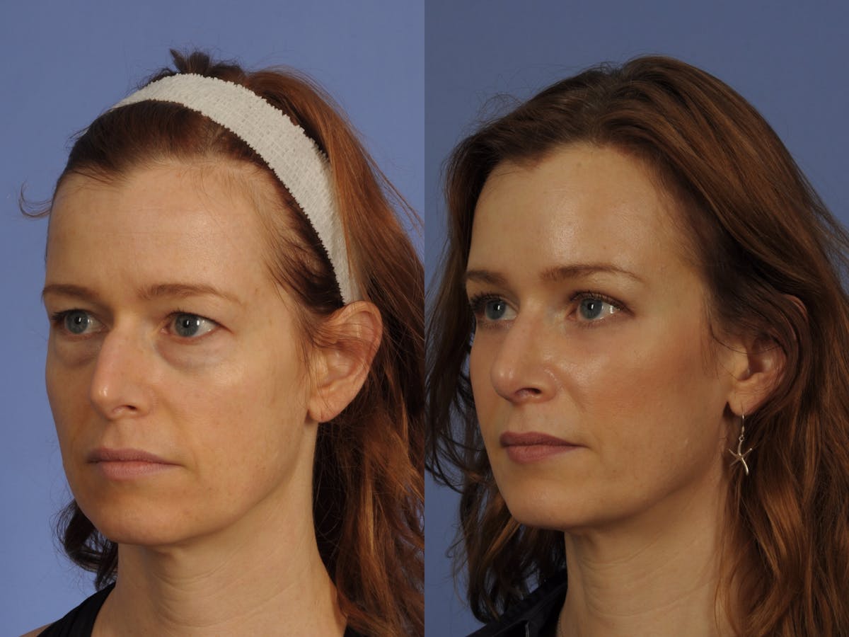 Mid Facelift Before & After Gallery - Patient 112110 - Image 2