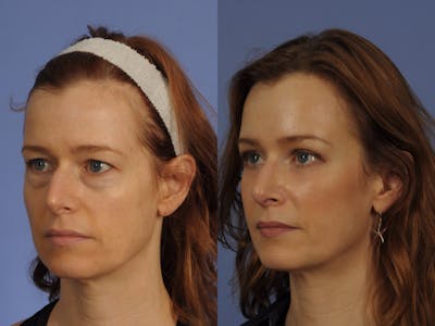 Mid Facelift Before & After Gallery - Patient 112110 - Image 2