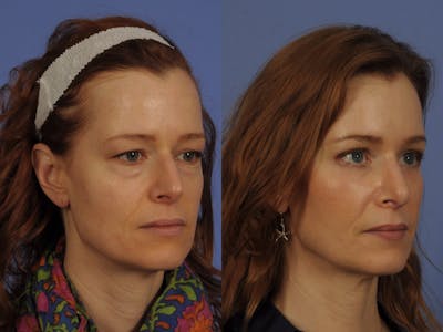 Mid Facelift Before & After Gallery - Patient 112110 - Image 3