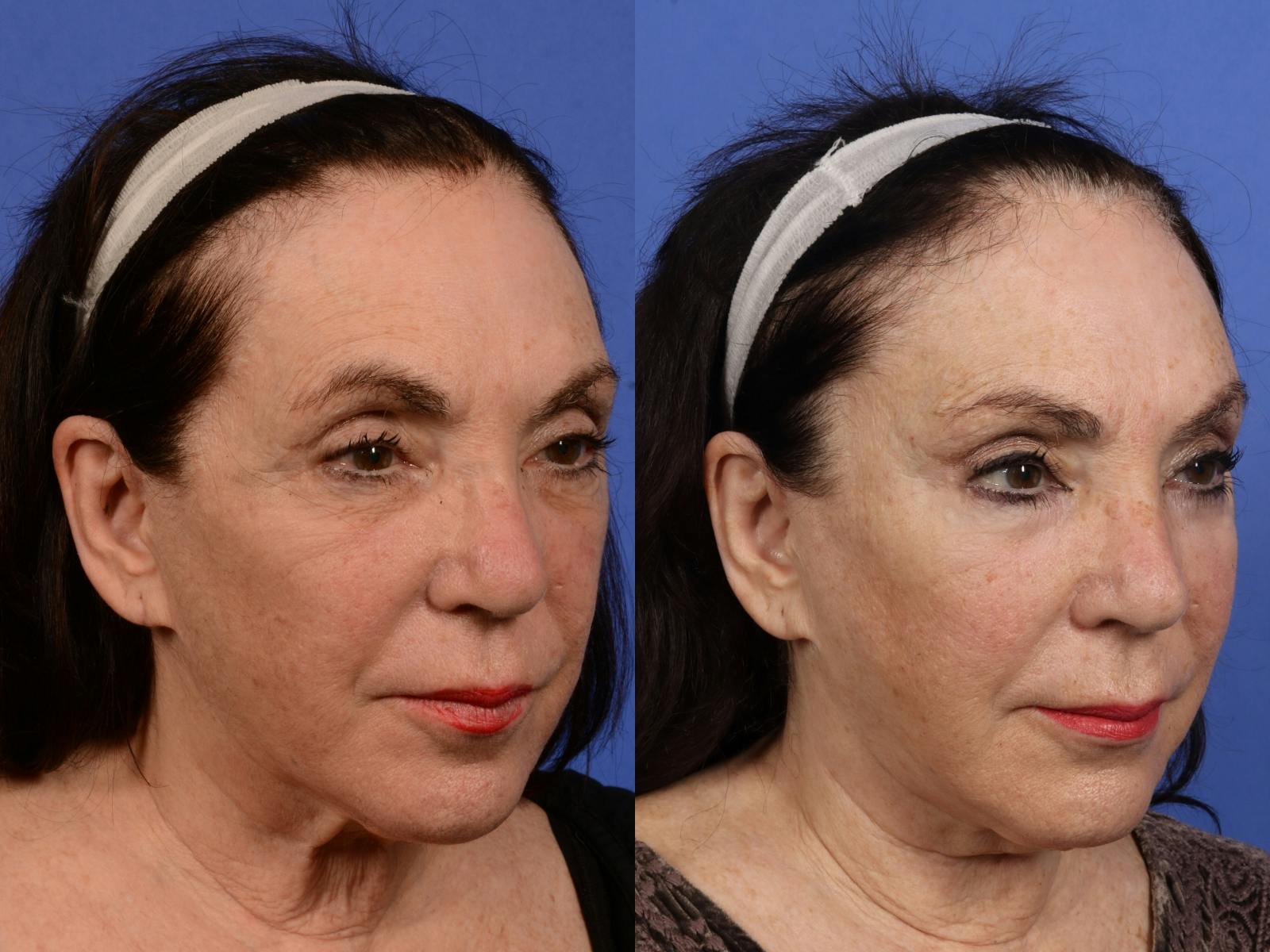 Mid Facelift Before & After Gallery - Patient 375862 - Image 2