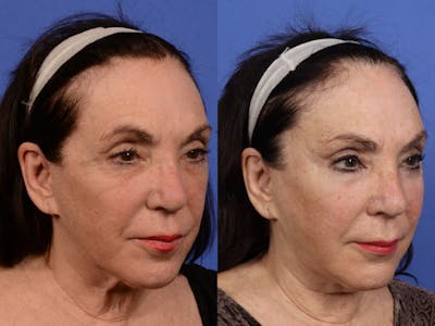 Mid Facelift Before & After Gallery - Patient 375862 - Image 2