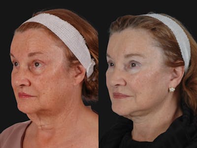 Mid Facelift Before & After Gallery - Patient 202388 - Image 3