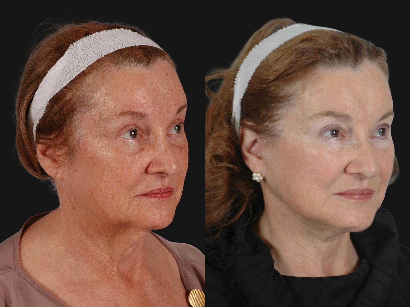 Mid Facelift Before & After Gallery - Patient 202388 - Image 2
