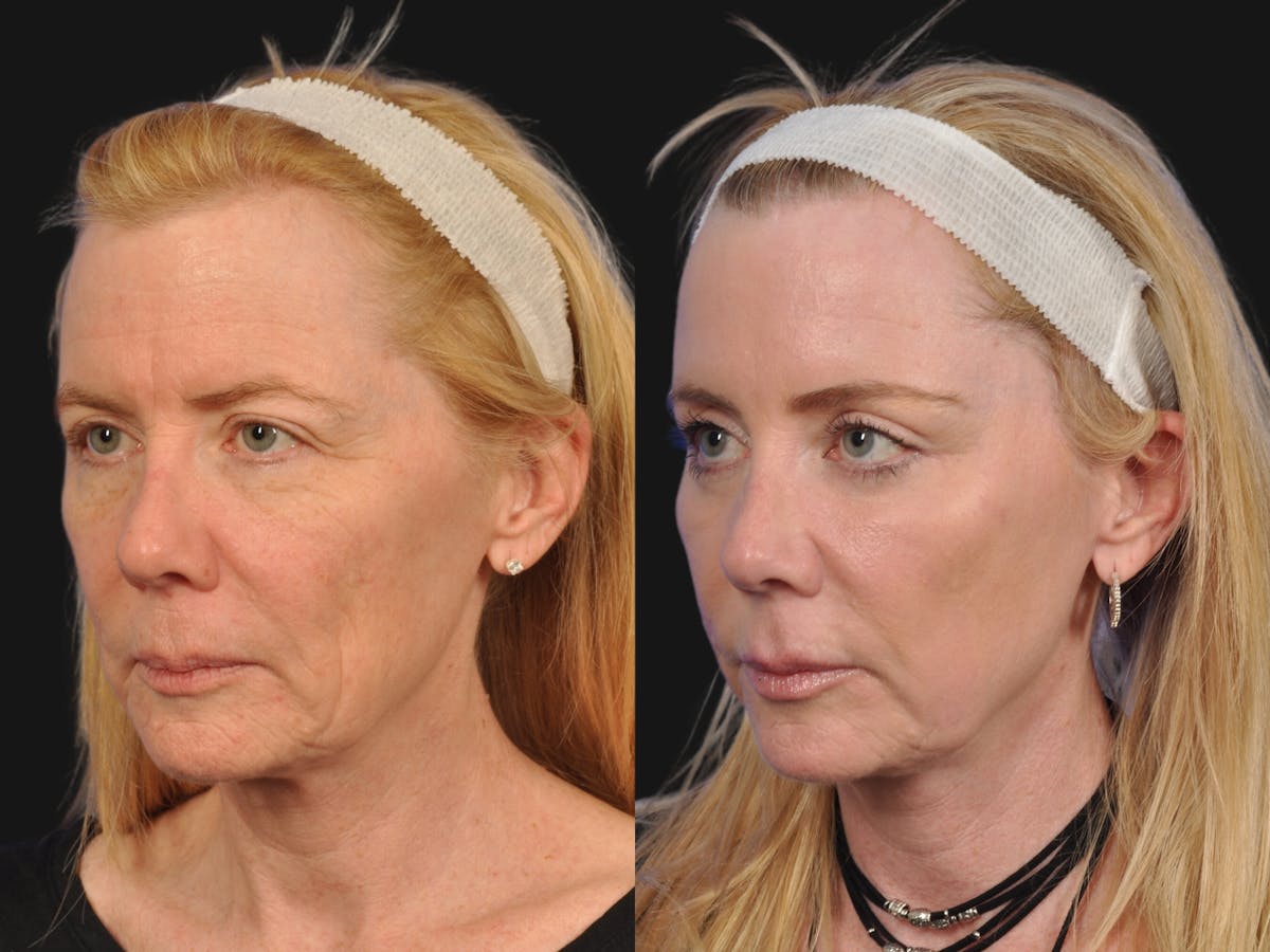 Mid Facelift Before & After Gallery - Patient 192282 - Image 3