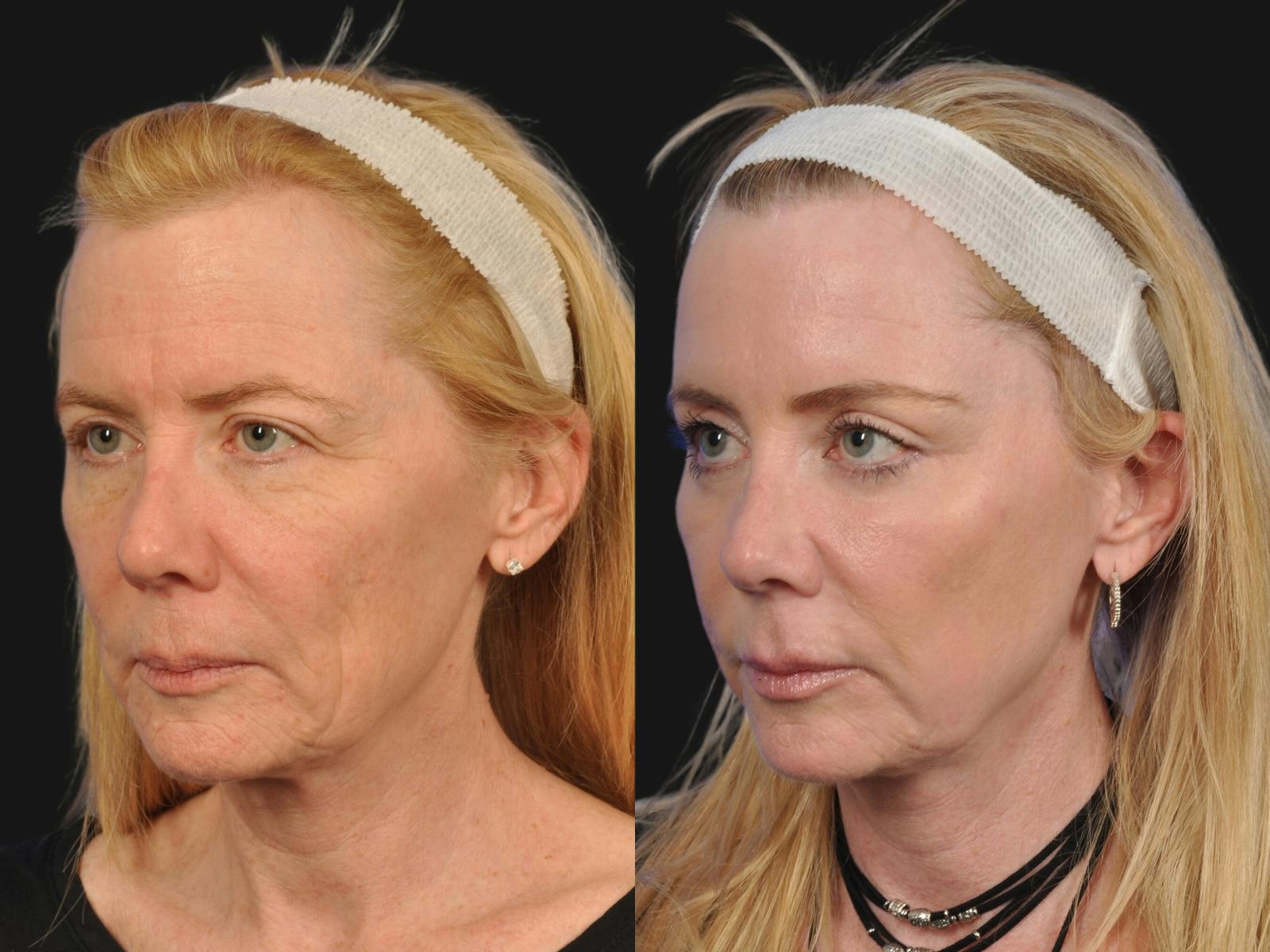 Mid Facelift Before & After Gallery - Patient 192282 - Image 3