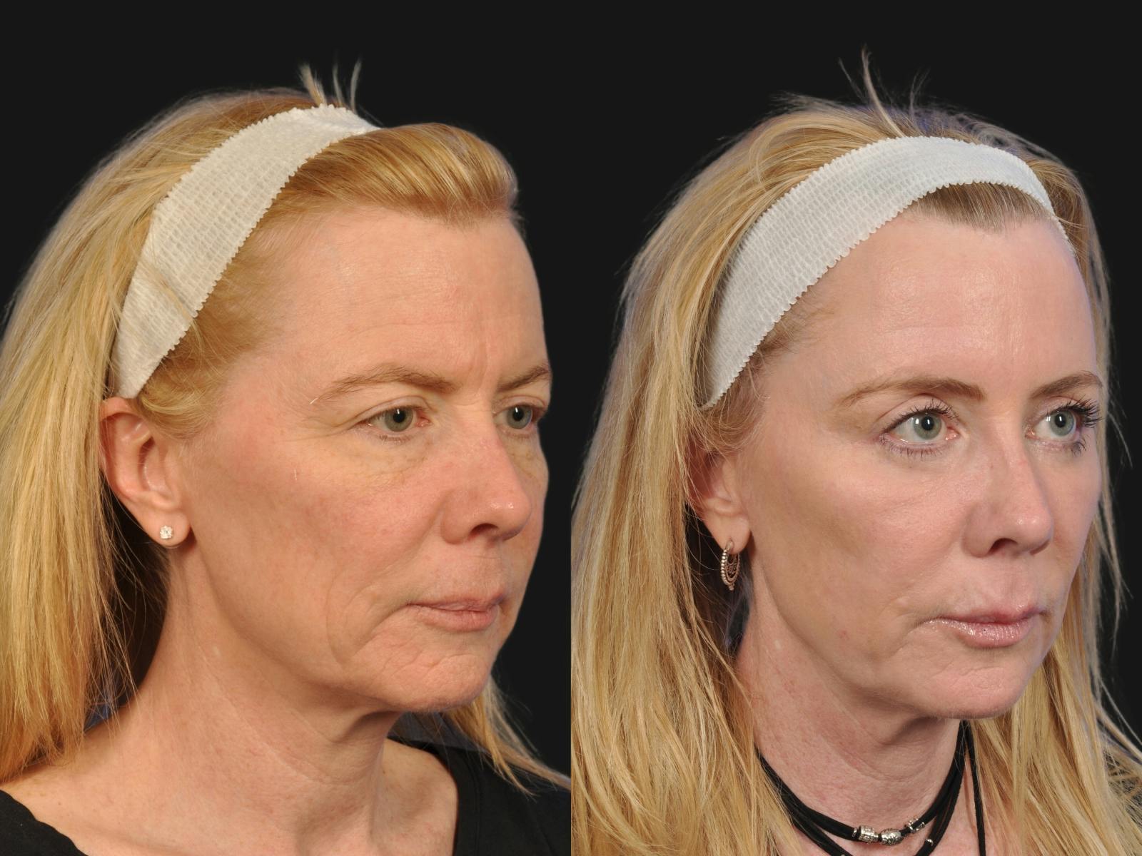 Mid Facelift Before & After Gallery - Patient 192282 - Image 2