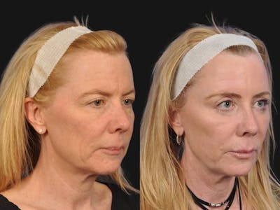 Mid Facelift Before & After Gallery - Patient 192282 - Image 2
