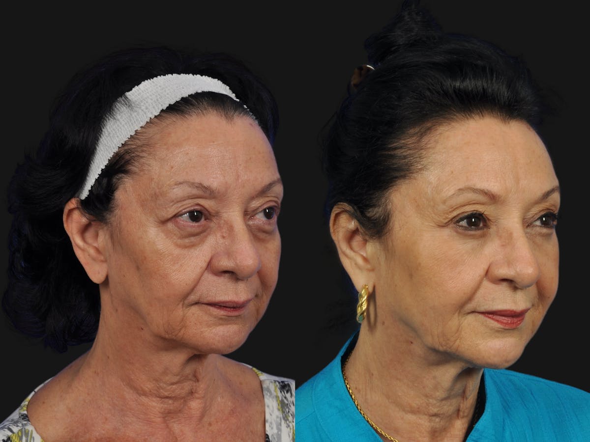 Mid Facelift Before & After Gallery - Patient 391598 - Image 3