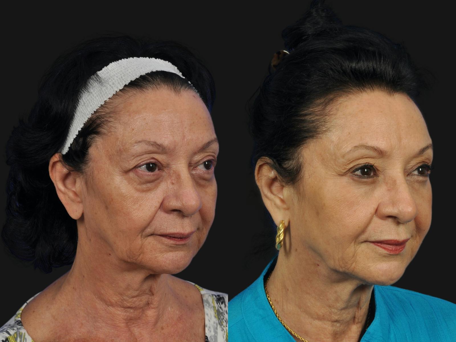 Mid Facelift Before & After Gallery - Patient 391598 - Image 3