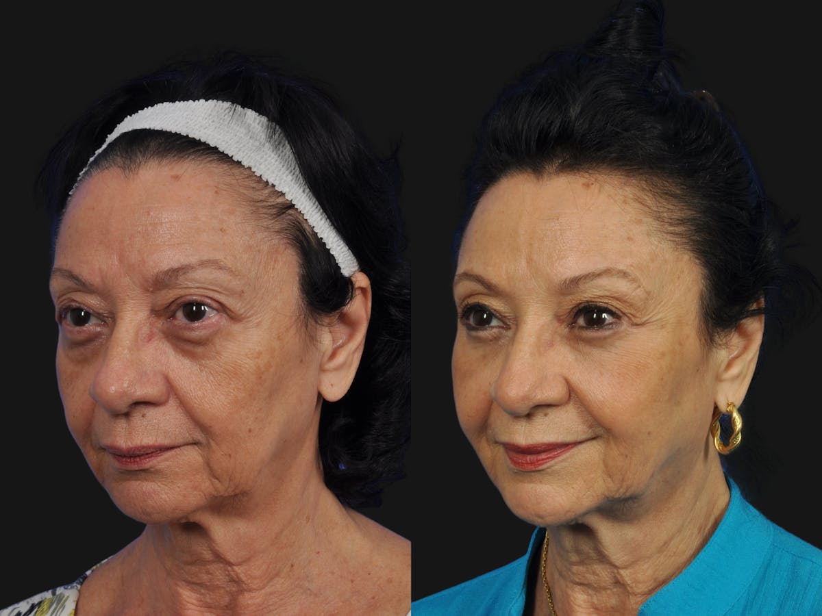 Mid Facelift Before & After Gallery - Patient 391598 - Image 4