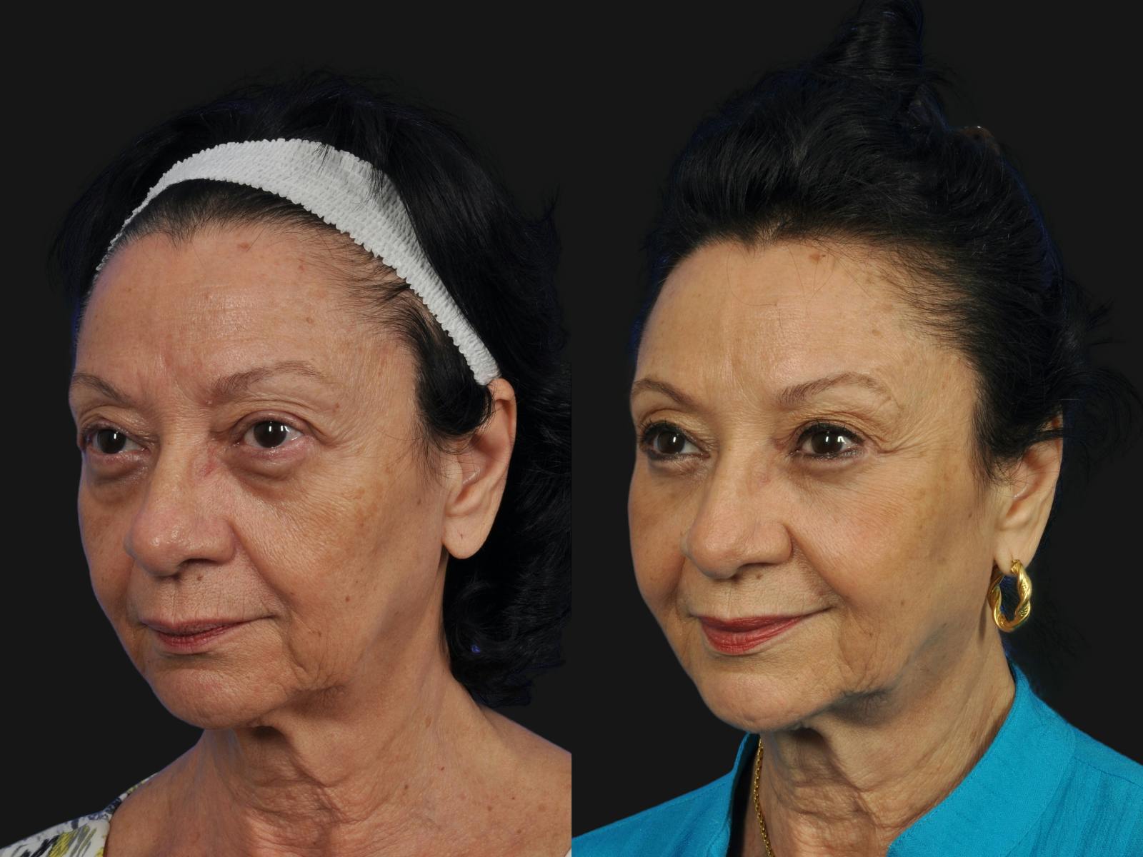 Mid Facelift Before & After Gallery - Patient 391598 - Image 4