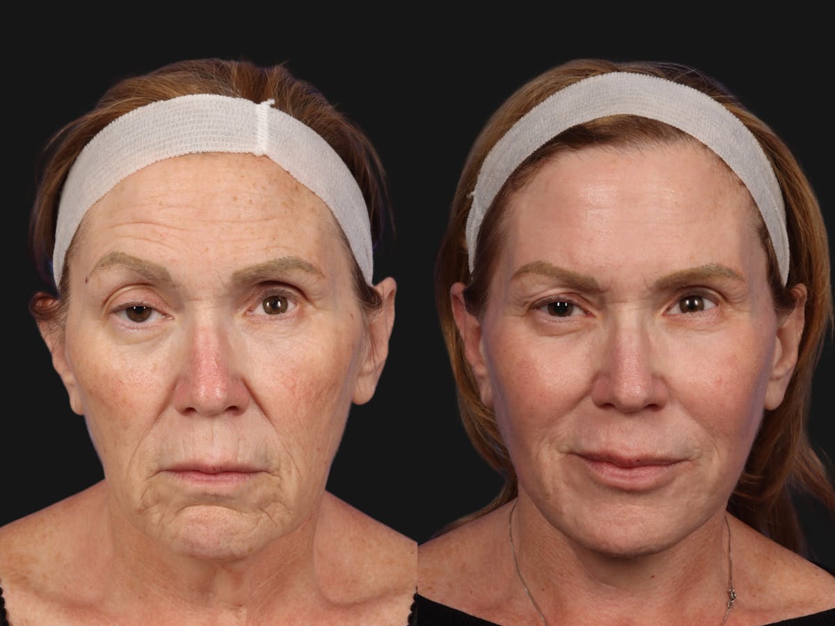 UltraClear™ Laser Before & After Gallery - Patient 223770 - Image 1