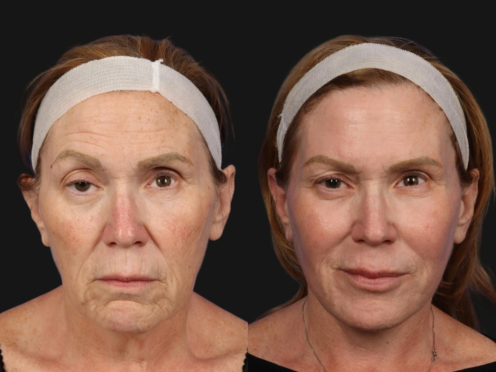 UltraClear™ Laser Before & After Gallery - Patient 223770 - Image 1