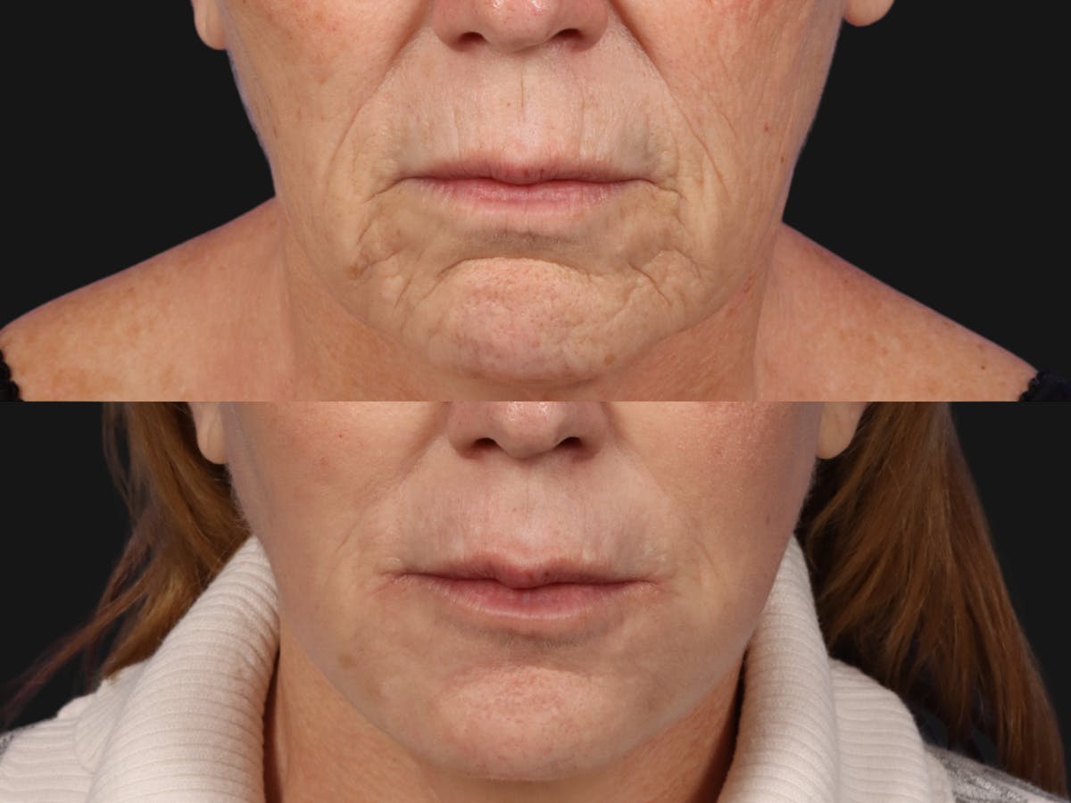 UltraClear™ Laser Before & After Gallery - Patient 223770 - Image 2