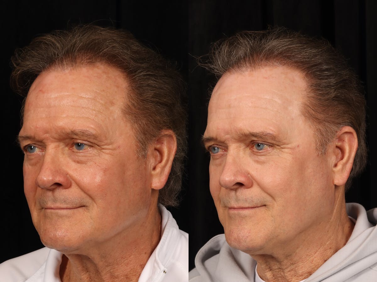 UltraClear™ Laser Before & After Gallery - Patient 405662 - Image 2