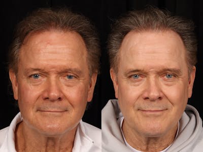 UltraClear™ Laser Before & After Gallery - Patient 405662 - Image 1
