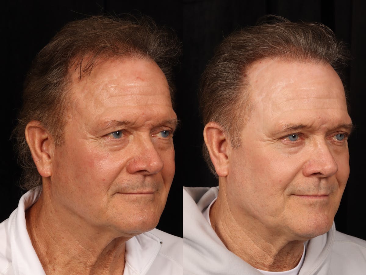 UltraClear™ Laser Before & After Gallery - Patient 405662 - Image 3