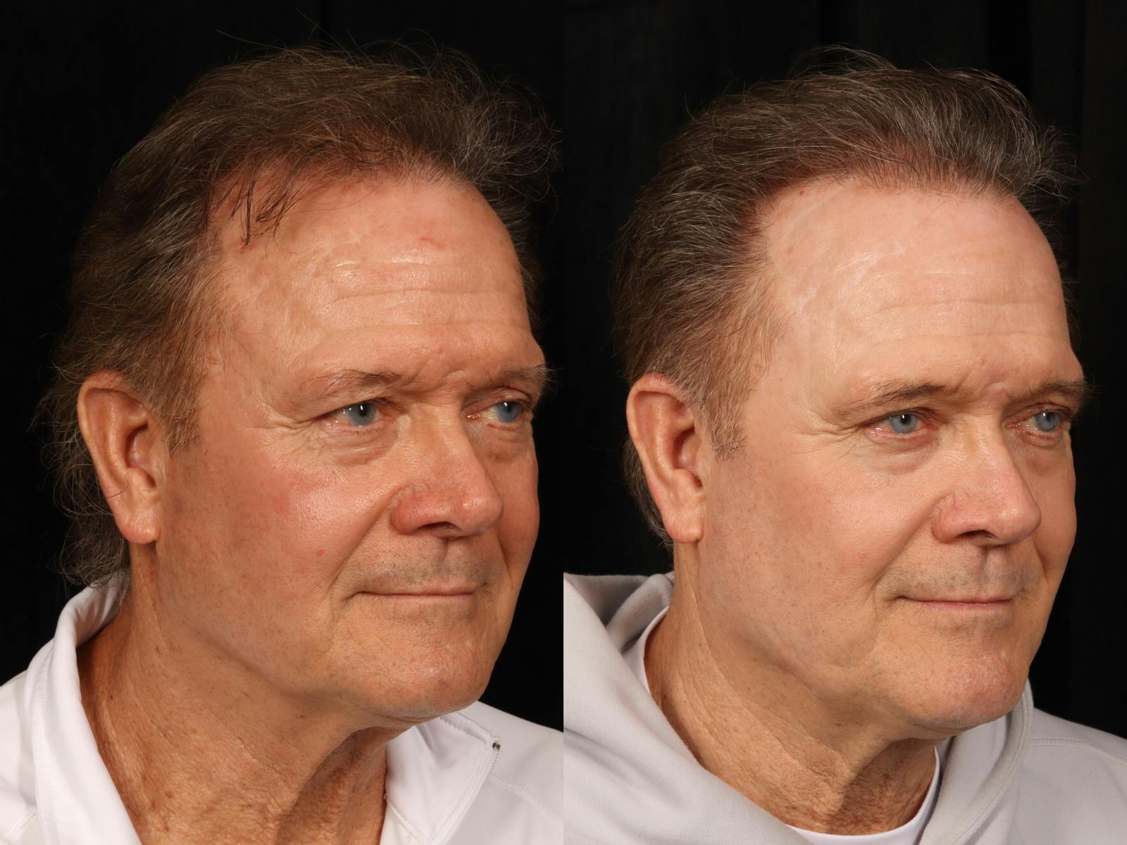 UltraClear™ Laser Before & After Gallery - Patient 405662 - Image 3