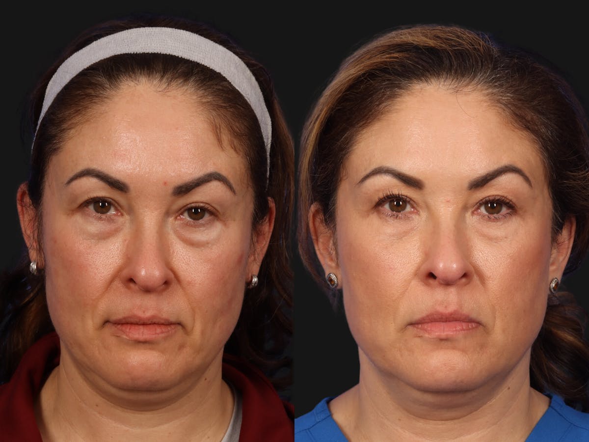 UltraClear™ Laser Before & After Gallery - Patient 237665 - Image 1