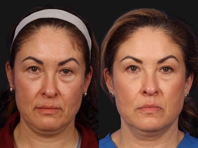 UltraClear™ Laser Before & After Gallery - Patient 237665 - Image 1