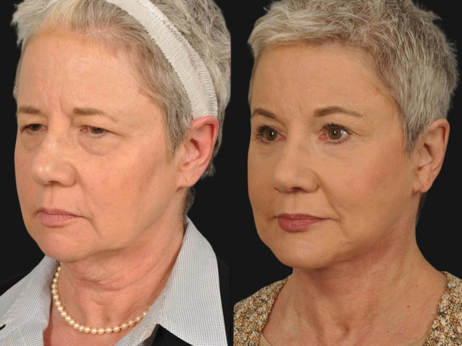 Mid Facelift Before & After Gallery - Patient 114405 - Image 3