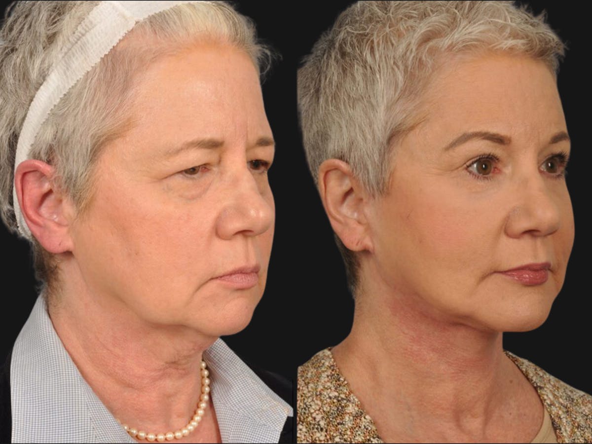 Mid Facelift Before & After Gallery - Patient 114405 - Image 2