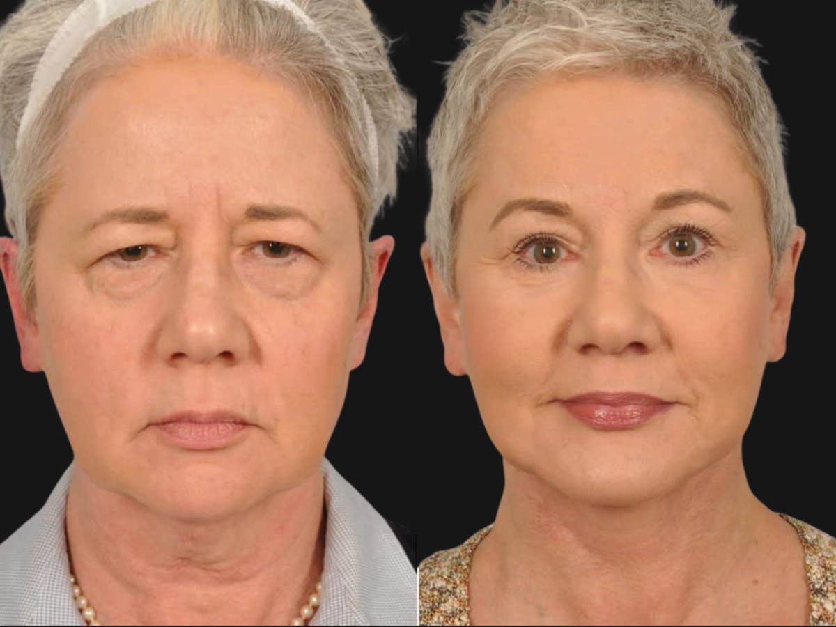 Mid Facelift Before & After Gallery - Patient 114405 - Image 1