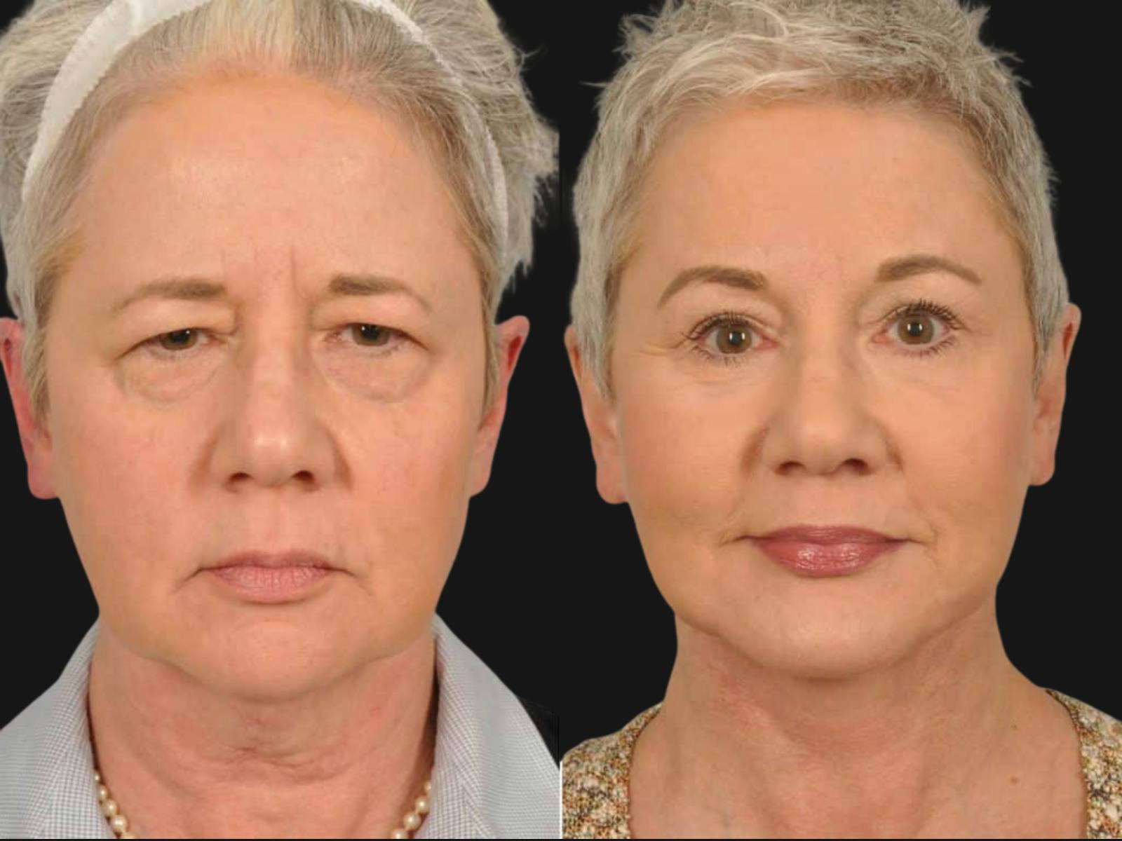 Mid Facelift Before & After Gallery - Patient 114405 - Image 1