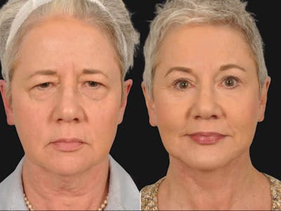 Mid Facelift Before & After Gallery - Patient 114405 - Image 1