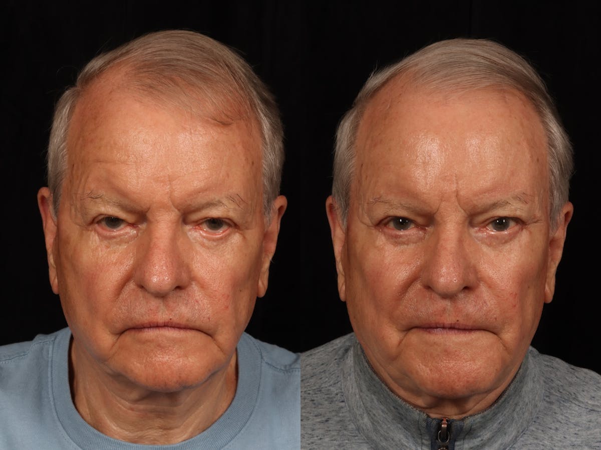 Blepharoplasty Before & After Gallery - Patient 265182 - Image 1