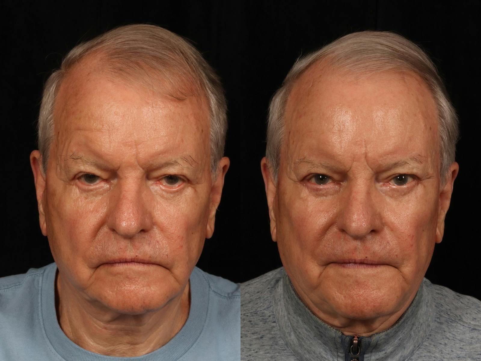 Blepharoplasty Before & After Gallery - Patient 265182 - Image 1