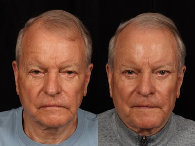 Blepharoplasty Before & After Gallery - Patient 265182 - Image 1