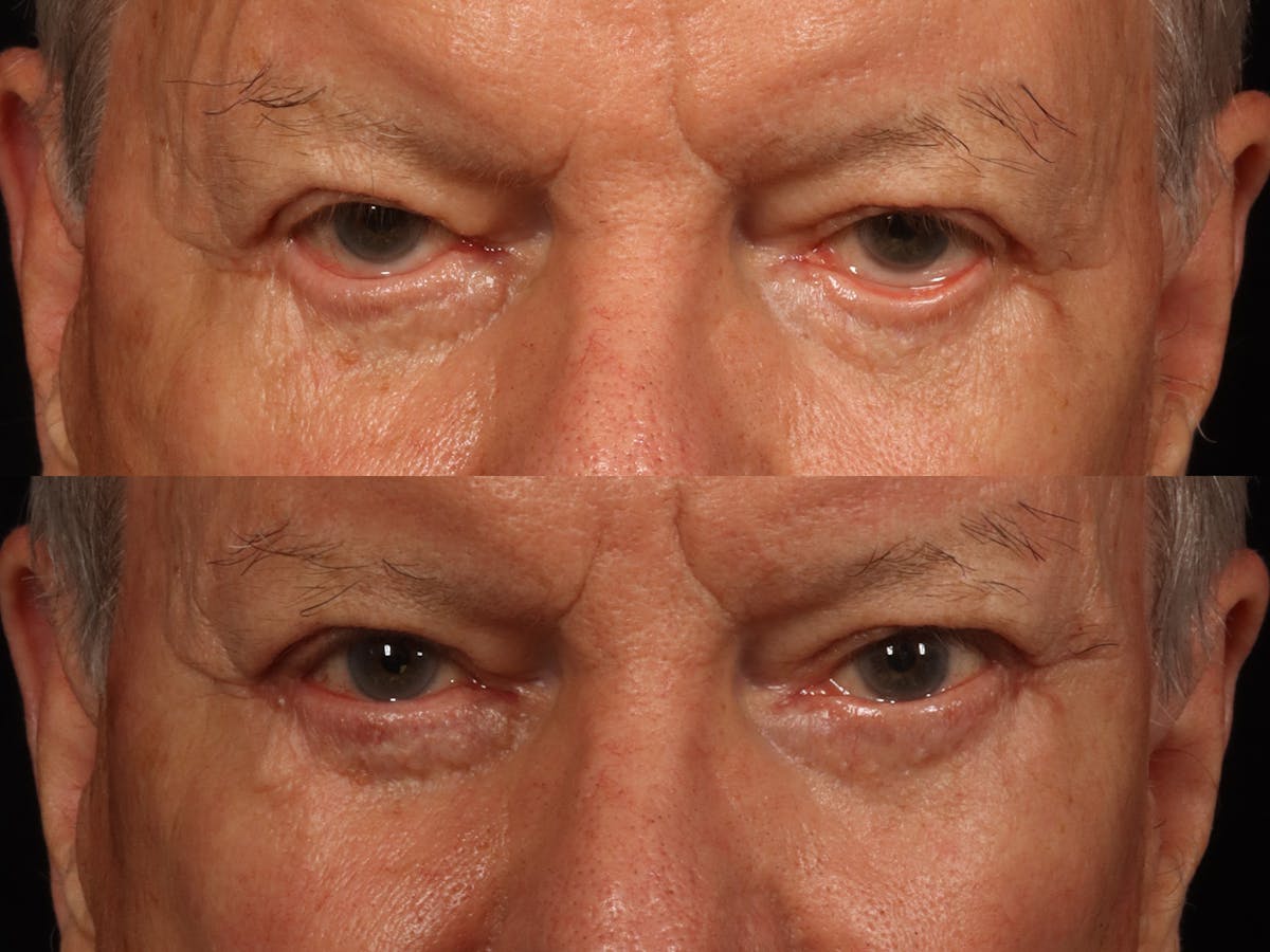Blepharoplasty Before & After Gallery - Patient 265182 - Image 2