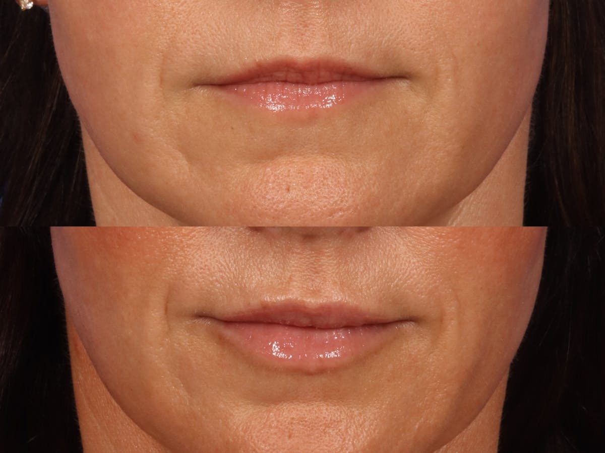 Lip filler on 43 year old woman