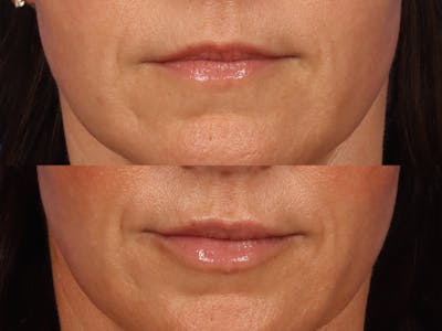 Lip filler on 43 year old woman