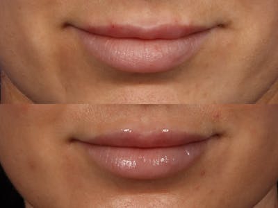 Lip Filler before and after