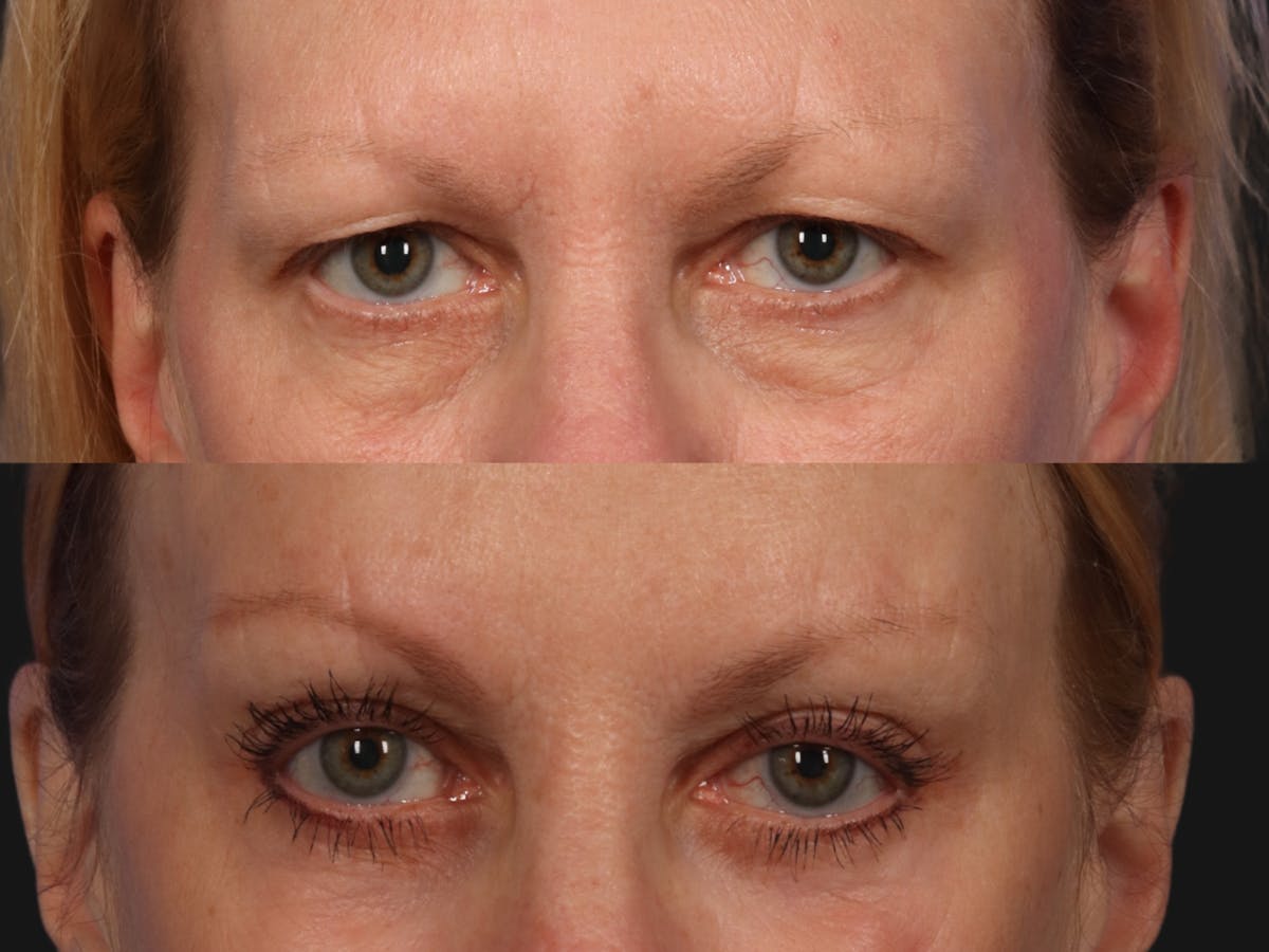 Brow Lift Before & After Gallery - Patient 273921 - Image 2