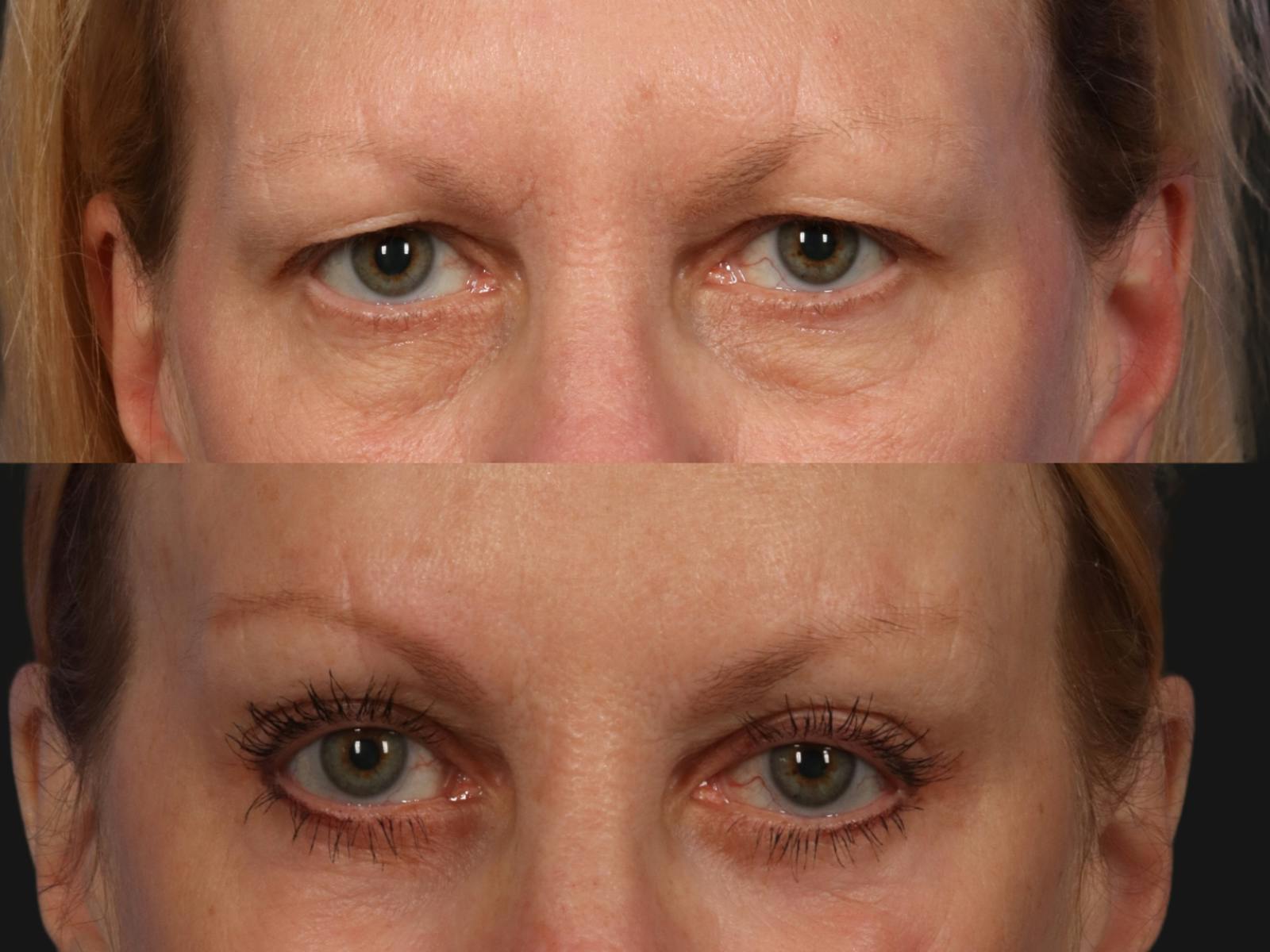 Liposculpture Before & After Gallery - Patient 237083 - Image 2