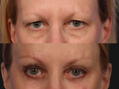 Liposculpture Before & After Gallery - Patient 237083 - Image 2
