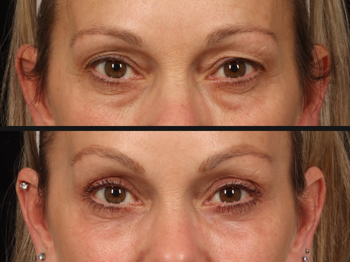 Blepharoplasty Before & After Gallery - Patient 772895 - Image 2