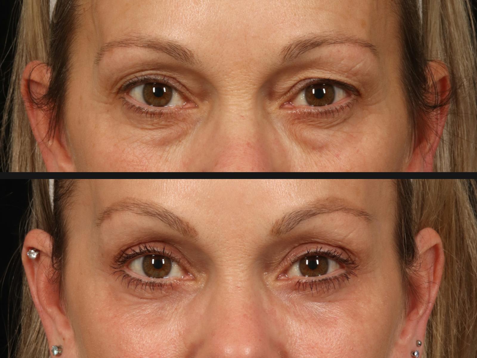 Blepharoplasty Before & After Gallery - Patient 772895 - Image 2